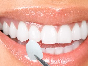 Porcelain-Veneers