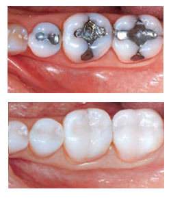 Tooth Colored Fillings