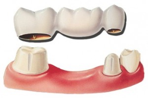 dental-bridge-diag